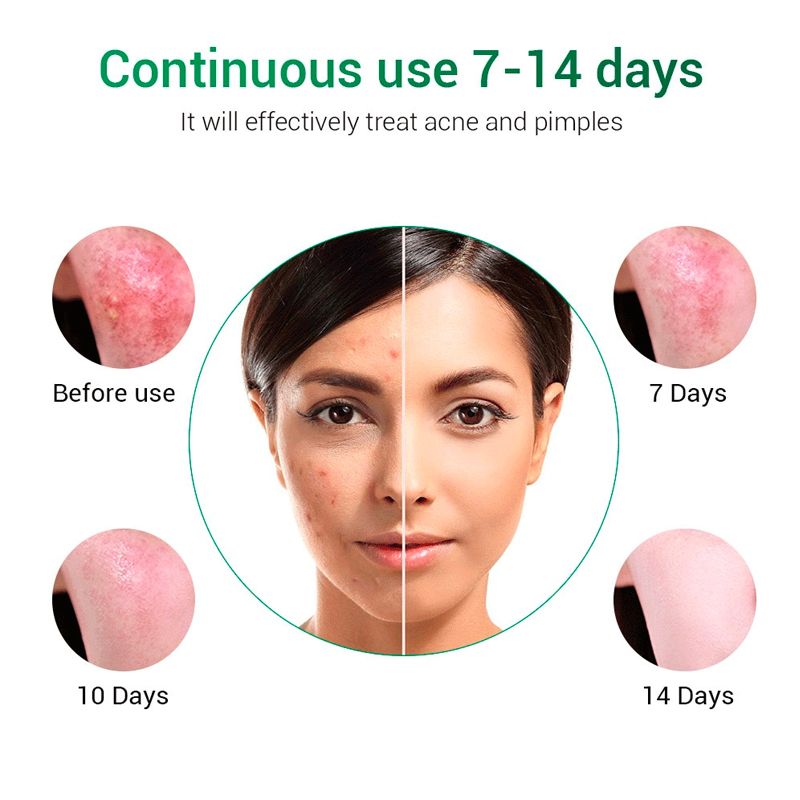Acne Night & Day Treatment_0007_Layer 10.jpg