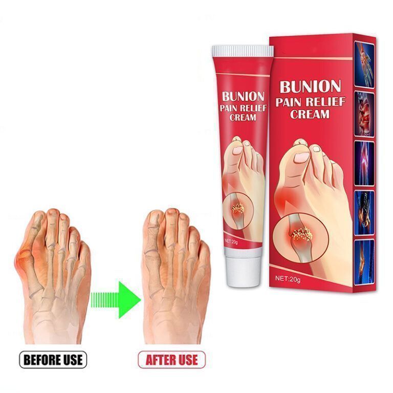 Bunion Pain Relief Cream - LuxyGlow