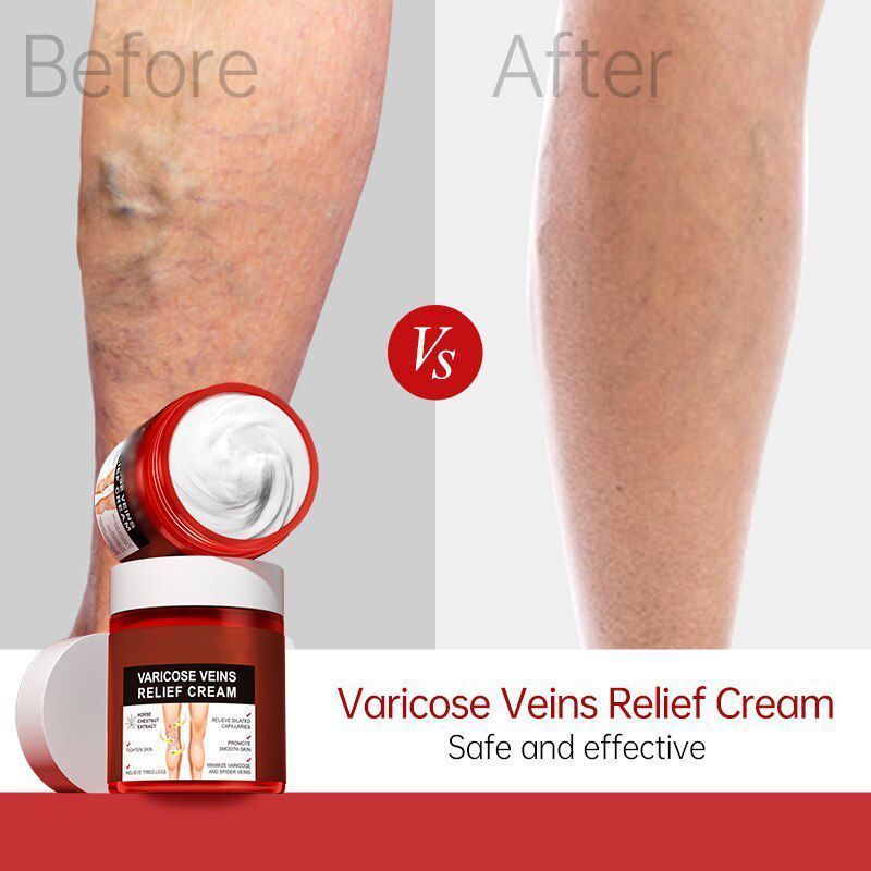 Varicose Veins Relief Cream10.jpg