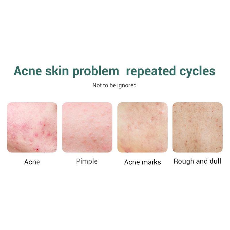 acne serum11.jpg