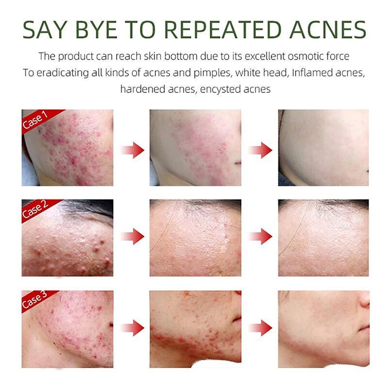 acne serum14.jpg