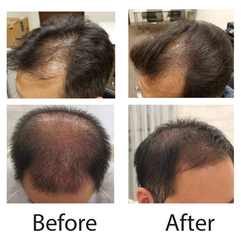 Hair Regrowth LED light therapy1.jpg
