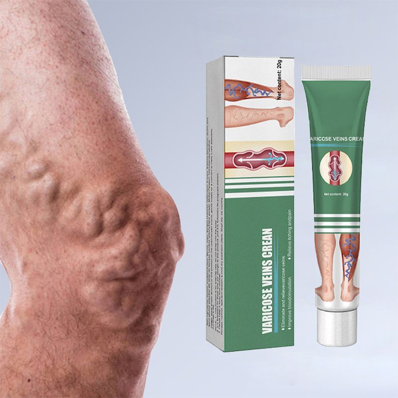 varicose veins cream1.jpg