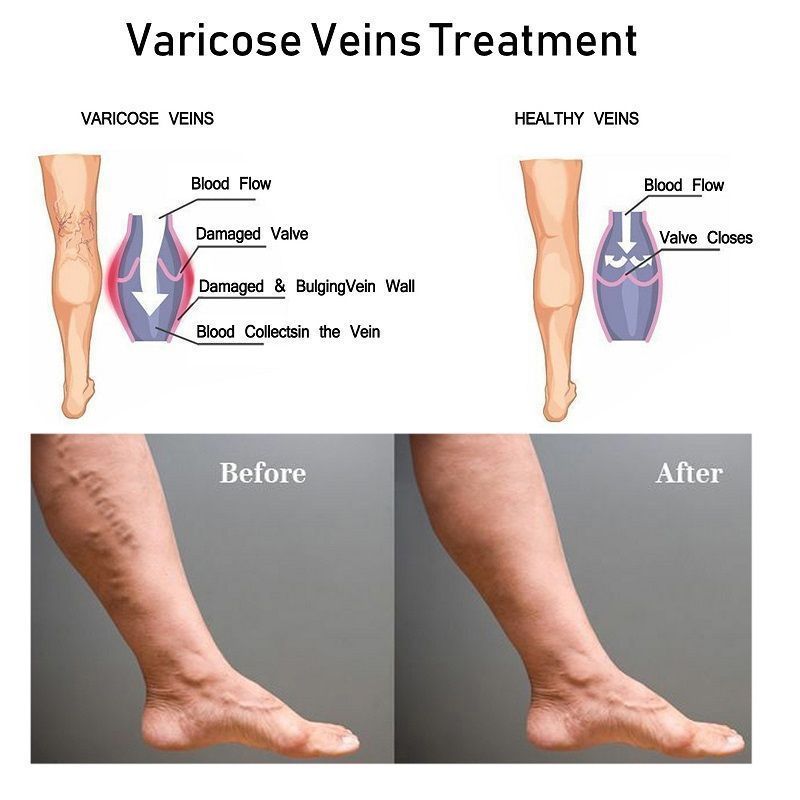 varicose veins cream10.jpg