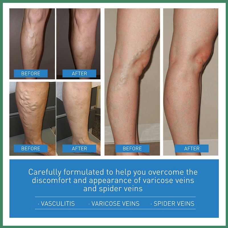 varicose veins cream2.jpg