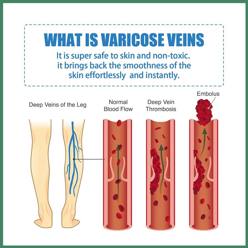 varicose veins cream3.jpg