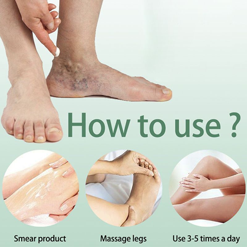 varicose veins cream6.jpg