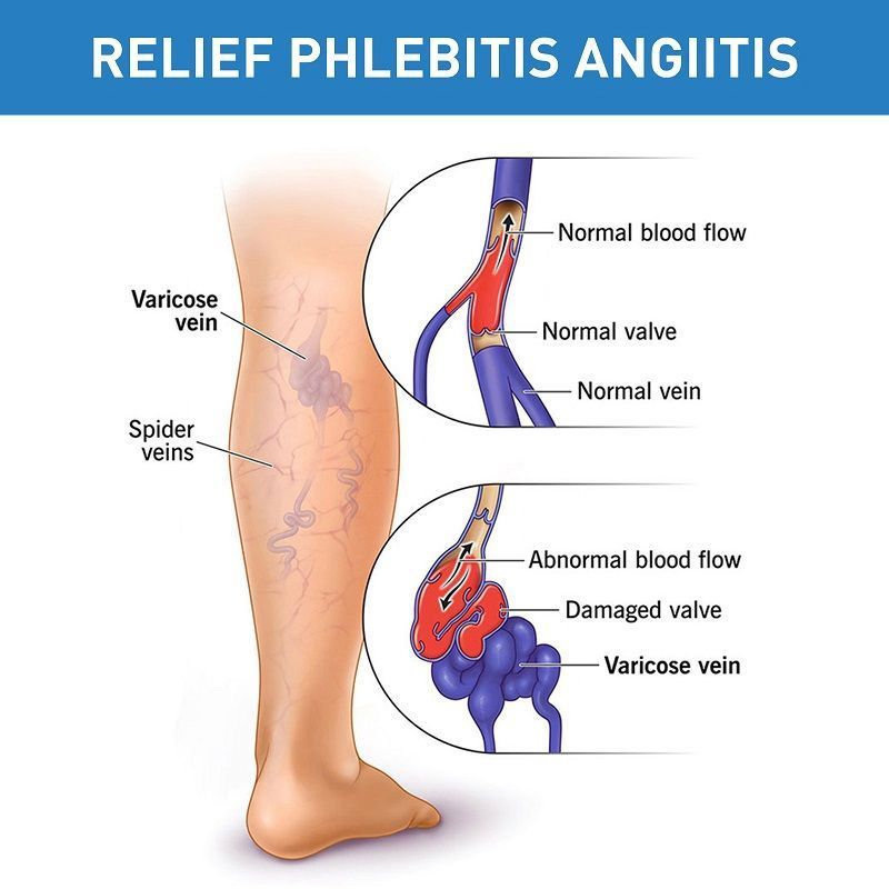 varicose veins cream9.jpg